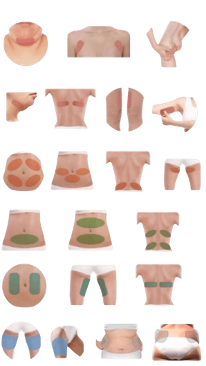 zones-traitables-cryolipolyse